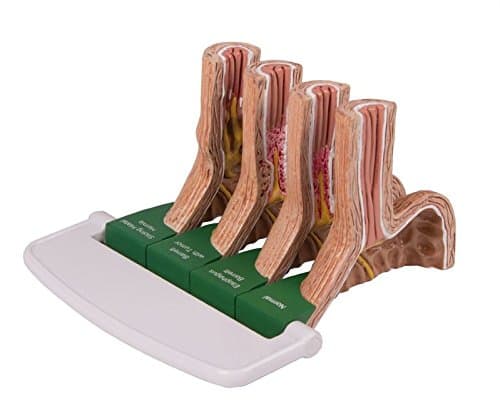 Gastroesophageal reflux diseas